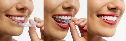 Ενδοστοματικές συσκευές, Κινητές συσκευές, Διαφανείς νάρθηκες